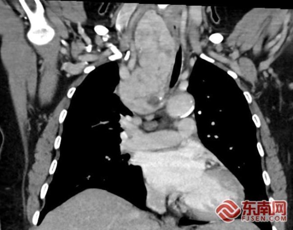 创牛配资 沪宁专家联手攻坚 12厘米胸骨后甲状腺肿微创切除